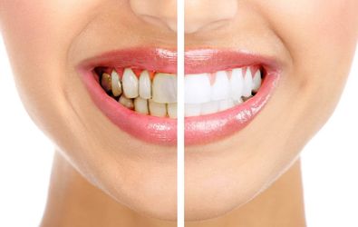 Як легко усунути зубний наліт без відвідин стоматолога