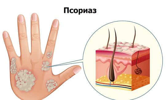 Излечим ли псориаз (чешуйчатый лишай)?